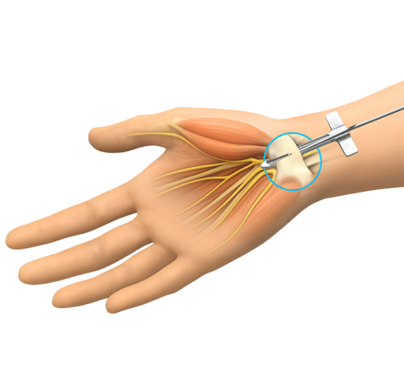 손목터널증후군
