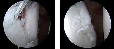 전방관절와순파열