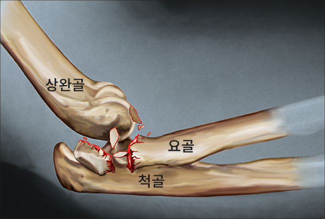 팔꿈치 골절