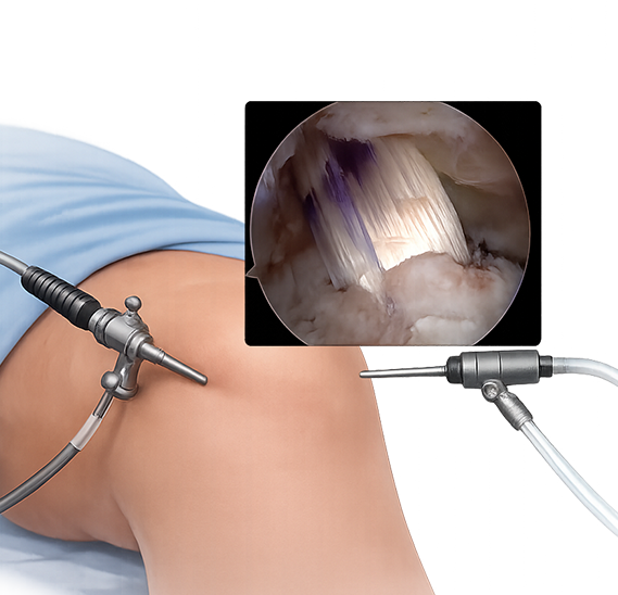 전방십자인대재건술