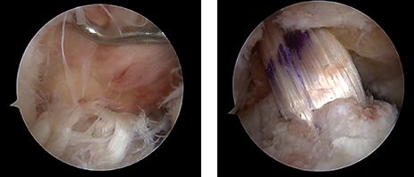 전방십자인대재건술
