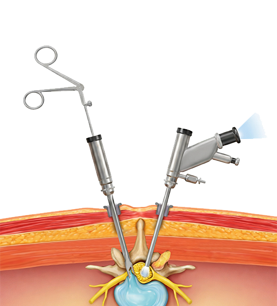 양방향척추내시경