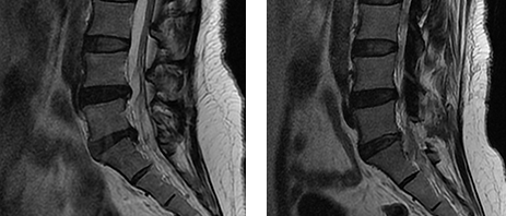 양방향척추내시경