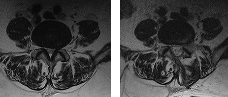 양방향척추내시경