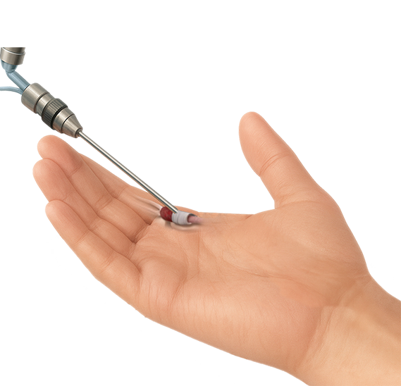 방아쇠수지증후군