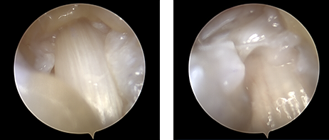 방아쇠수지증후군